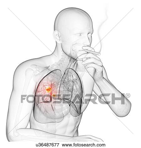 Stock Illustration - Lung cancer due to smoking, artwork. Fotosearch