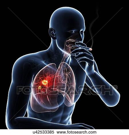 Stock Illustration - Lung cancer due to smoking, artwork. Fotosearch