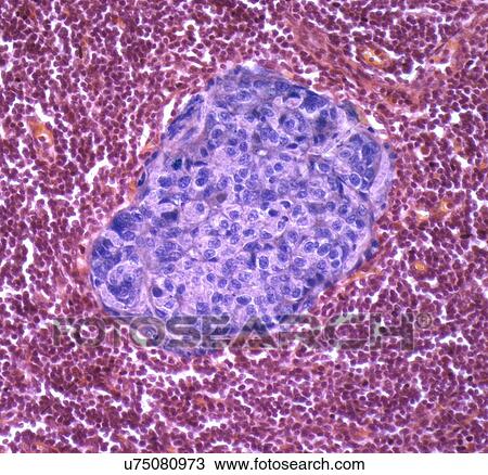Metastatic breast cancer View Large Illustration Drawing - Metastatic breast cancer. Fotosearch