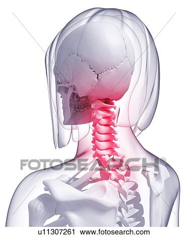 Clip Art - Neck pain, artwork. Fotosearch