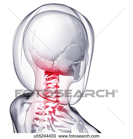 Neck pain, artwork View Large Illustration Drawing - Neck pain, artwork. Fotosearch