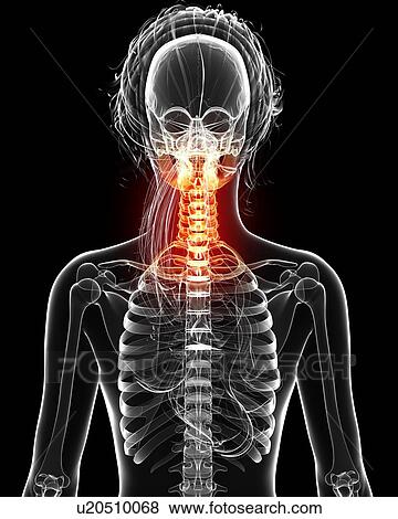 Neck pain, artwork View Large Illustration Stock Illustration - Neck pain, artwork. Fotosearch