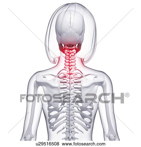 Stock Illustration - Neck pain, artwork. Fotosearch