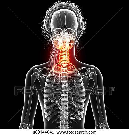 Neck pain, artwork View Large Illustration Stock Illustration - Neck pain, artwork. Fotosearch