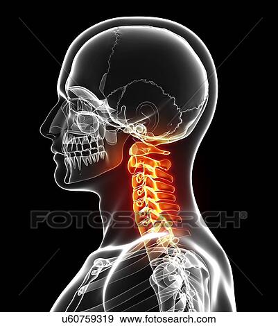 Neck pain, artwork View Large Illustration Stock Illustration - Neck pain, artwork. Fotosearch