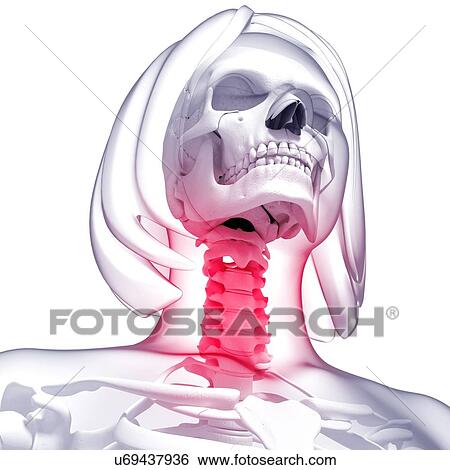 Stock Illustration - Neck pain, artwork. Fotosearch