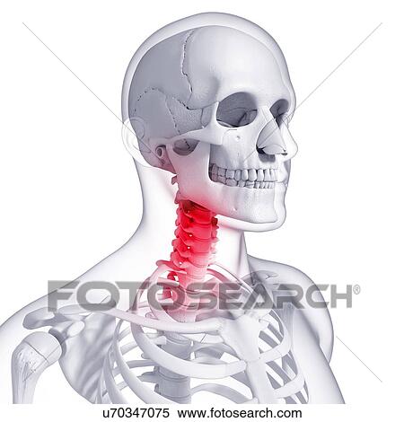 Neck pain, artwork View Large Illustration Stock Illustration - Neck pain, artwork. Fotosearch