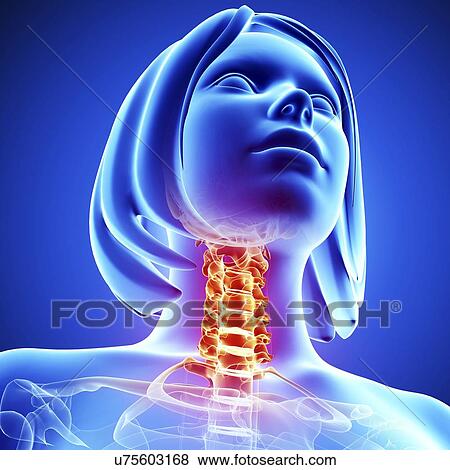 Neck pain, artwork View Large Illustration Stock Illustration - Neck pain, artwork. Fotosearch
