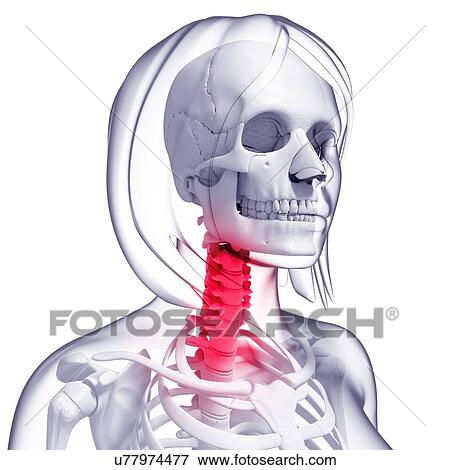 Neck pain, artwork View Large Illustration Stock Illustration - Neck pain, artwork. Fotosearch