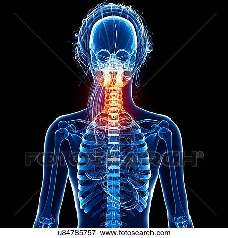 Stock Illustration - Neck pain, artwork. Fotosearch
