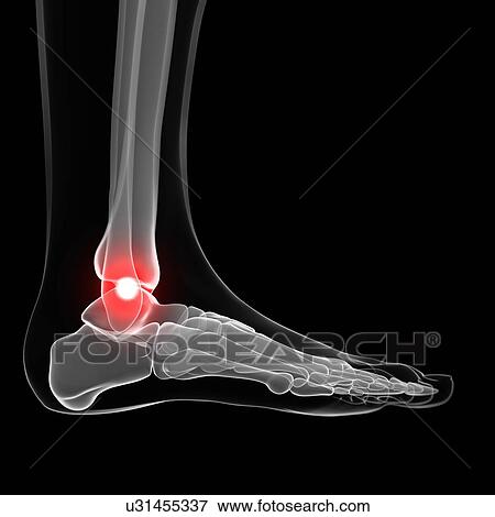 Painful ankle, artwork View Large Illustration Stock Illustration - Painful ankle, artwork. Fotosearch