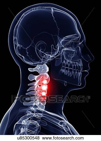 Painful cervical spine, artwork View Large Illustration Stock Illustration - Painful cervical spine, artwork. Fotosearch