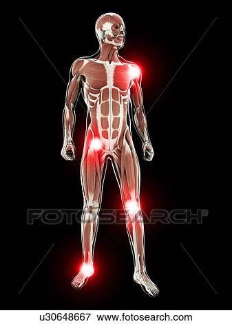 Painful joints, artwork View Large Illustration Stock Illustration - Painful joints, artwork. Fotosearch