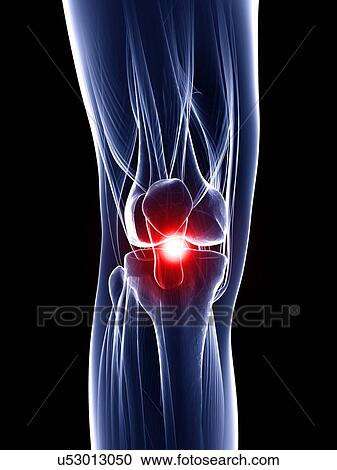 Clipart - Painful knee, artwork. Fotosearch
