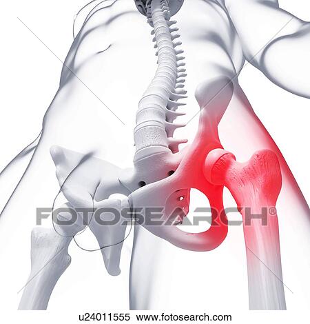 Stock Illustration - Pelvic pain, artwork. Fotosearch
