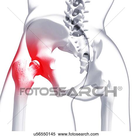 Pelvic pain, artwork View Large Illustration Stock Illustration - Pelvic pain, artwork. Fotosearch