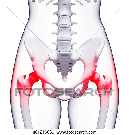 Stock Illustration - Pelvic pain, artwork. Fotosearch
