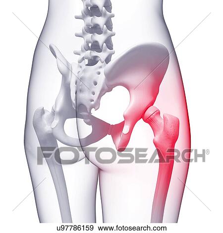 Pelvic pain, artwork View Large Illustration Stock Illustration - Pelvic pain, artwork. Fotosearch