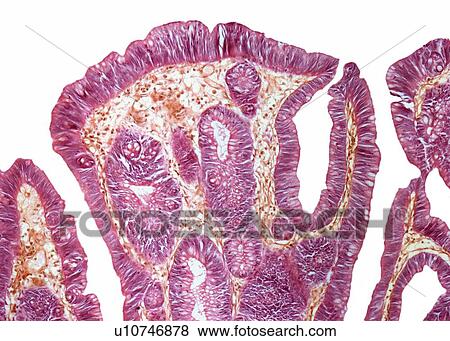 Stock Illustration - Rectal papilloma, light micrograph. Fotosearch
