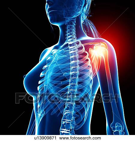 Clip Art - Shoulder pain, artwork. Fotosearch