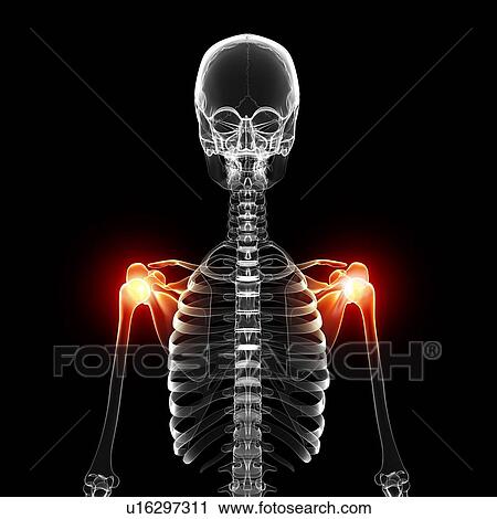 Clip Art - Shoulder pain, artwork. Fotosearch