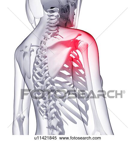 Shoulder pain, artwork View Large Illustration Stock Illustration - Shoulder pain, artwork. Fotosearch