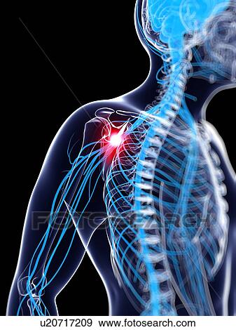 Shoulder pain, artwork View Large Illustration Stock Illustration - Shoulder pain, artwork. Fotosearch