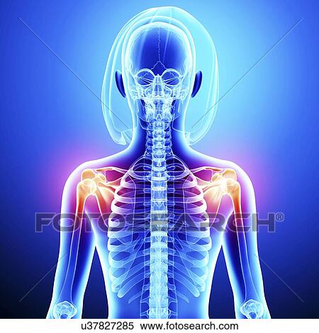 Stock Illustration - Shoulder pain, artwork. Fotosearch