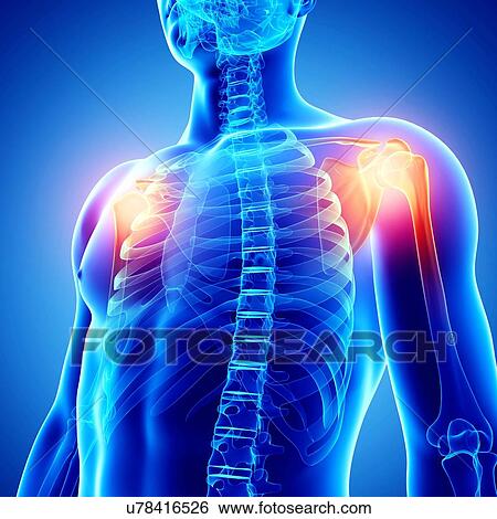 Stock Illustration - Shoulder pain, artwork. Fotosearch