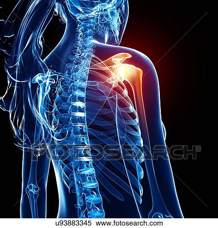 Shoulder pain, artwork View Large Illustration Stock Illustration - Shoulder pain, artwork. Fotosearch