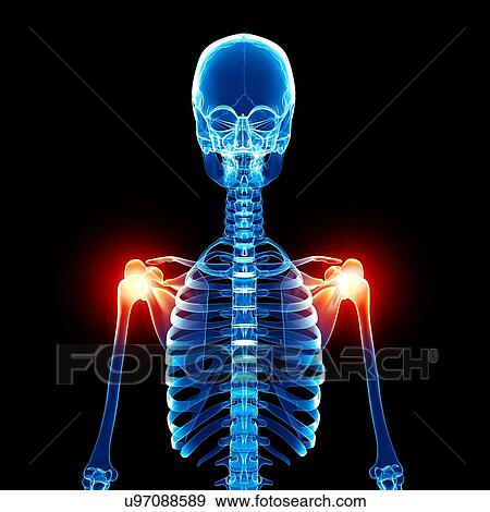 Stock Illustration - Shoulder pain, artwork. Fotosearch