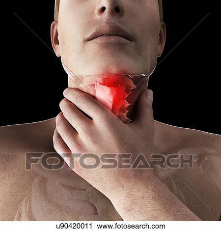 Sore throat, artwork View Large Illustration Clip Art - Sore throat, artwork. Fotosearch