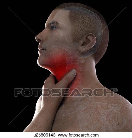 Sore throat, artwork View Large Illustration Drawing - Sore throat, artwork. Fotosearch