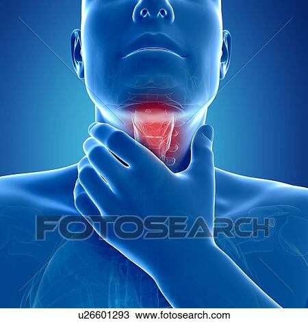 Sore throat, artwork View Large Illustration Drawing - Sore throat, artwork. Fotosearch