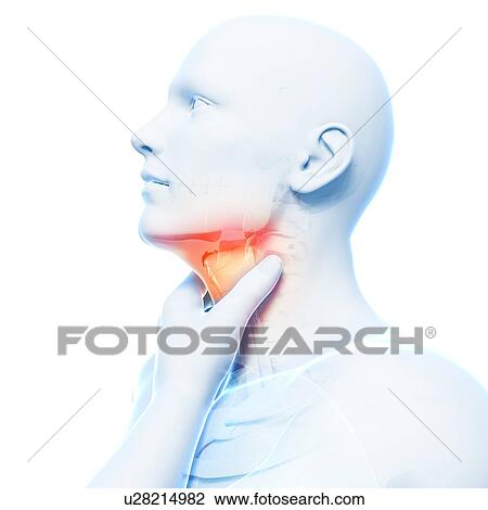 Sore throat, artwork View Large Illustration Drawing - Sore throat, artwork. Fotosearch
