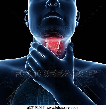 Stock Illustration - Sore throat, artwork. Fotosearch