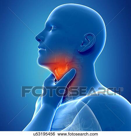 Stock Illustration - Sore throat, artwork. Fotosearch