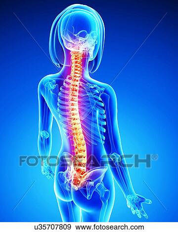 Stock Illustration - Spine pain, artwork. Fotosearch