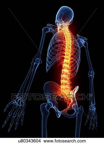 Spine pain, artwork View Large Illustration Stock Illustration - Spine pain, artwork. Fotosearch