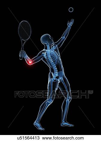 Tennis elbow, artwork View Large Illustration Drawing - Tennis elbow, artwork. Fotosearch