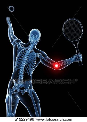 Tennis elbow, artwork View Large Illustration Stock Illustration - Tennis elbow, artwork. Fotosearch