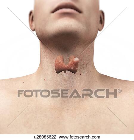 Thyroid gland cancer, artwork View Large Illustration Drawing - Thyroid gland cancer, artwork. Fotosearch