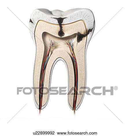 Tooth decay, artwork View Large Illustration Drawing - Tooth decay, artwork. Fotosearch