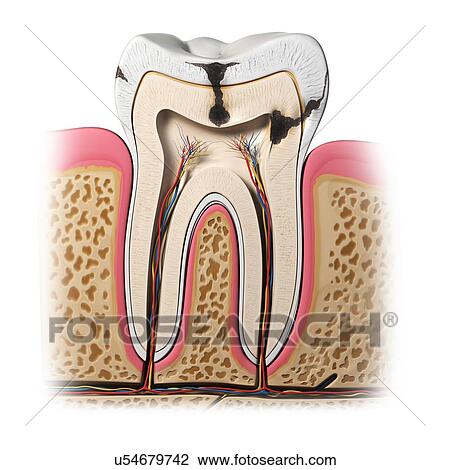Drawing - Tooth decay, artwork. Fotosearch