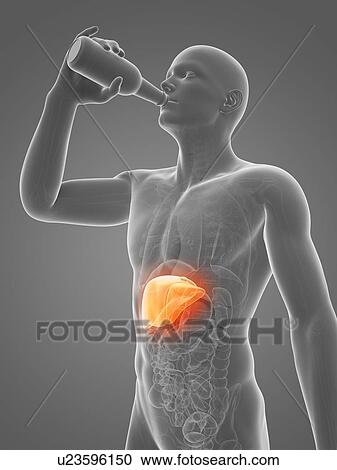 Alcoholic liver disease, artwork View Large Illustration Clipart - Alcoholic liver disease, artwork. Fotosearch