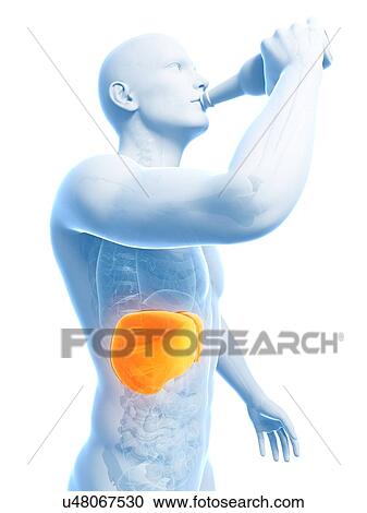 Clipart - Alcoholic liver disease, artwork. Fotosearch