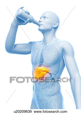 Alcoholic liver disease, artwork View Large Illustration Stock Illustration - Alcoholic liver disease, artwork. Fotosearch
