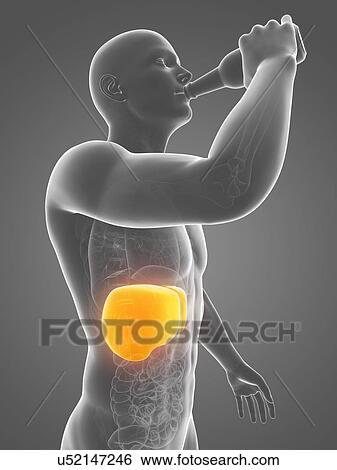 Alcoholic liver disease, artwork View Large Illustration Stock Illustration - Alcoholic liver disease, artwork. Fotosearch