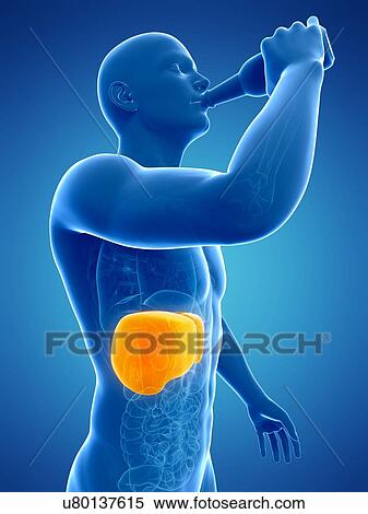 Alcoholic liver disease, artwork View Large Illustration Stock Illustration - Alcoholic liver disease, artwork. Fotosearch
