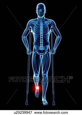 Ankle pain, conceptual artwork View Large Illustration Stock Illustration - Ankle pain, conceptual artwork. Fotosearch